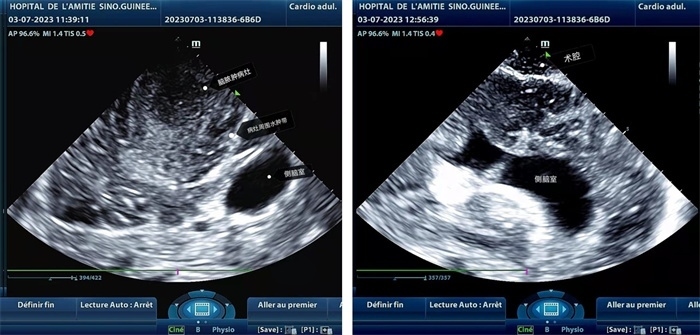 左圖顯示術(shù)中超聲見囊實性病變，大小約為4x4x3cm，病灶周圍腦組織水腫明顯；右圖為病灶切除后，術(shù)中超聲示術(shù)腔無病變殘留